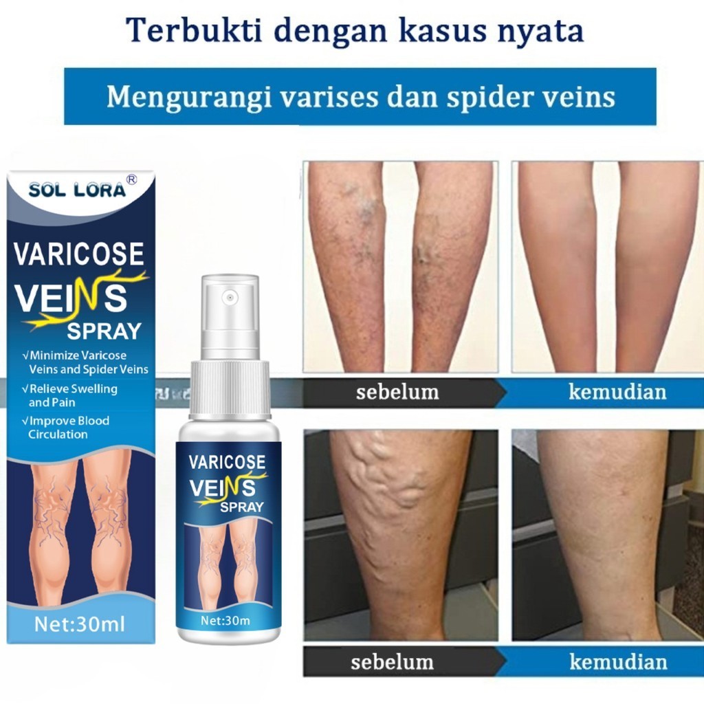 Varicose Veins Spray Obat Varises Salep Penghilang Varises Vaskulitis / Parises Ampuh Tanpa Operasi 
