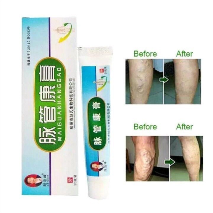 Obat Krim Penghilang Varises Maiguankanggao / Varicose Veins Treatment Cream Salep Cina Herbal Paris
