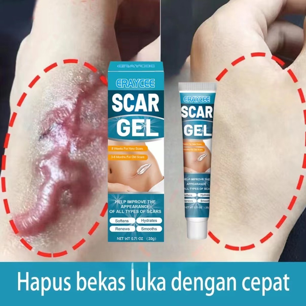 Scar removal gel Salep penghilang bekas luka Penghilang Gel Penghilang Bekas Luka Hilang Cream Keloi