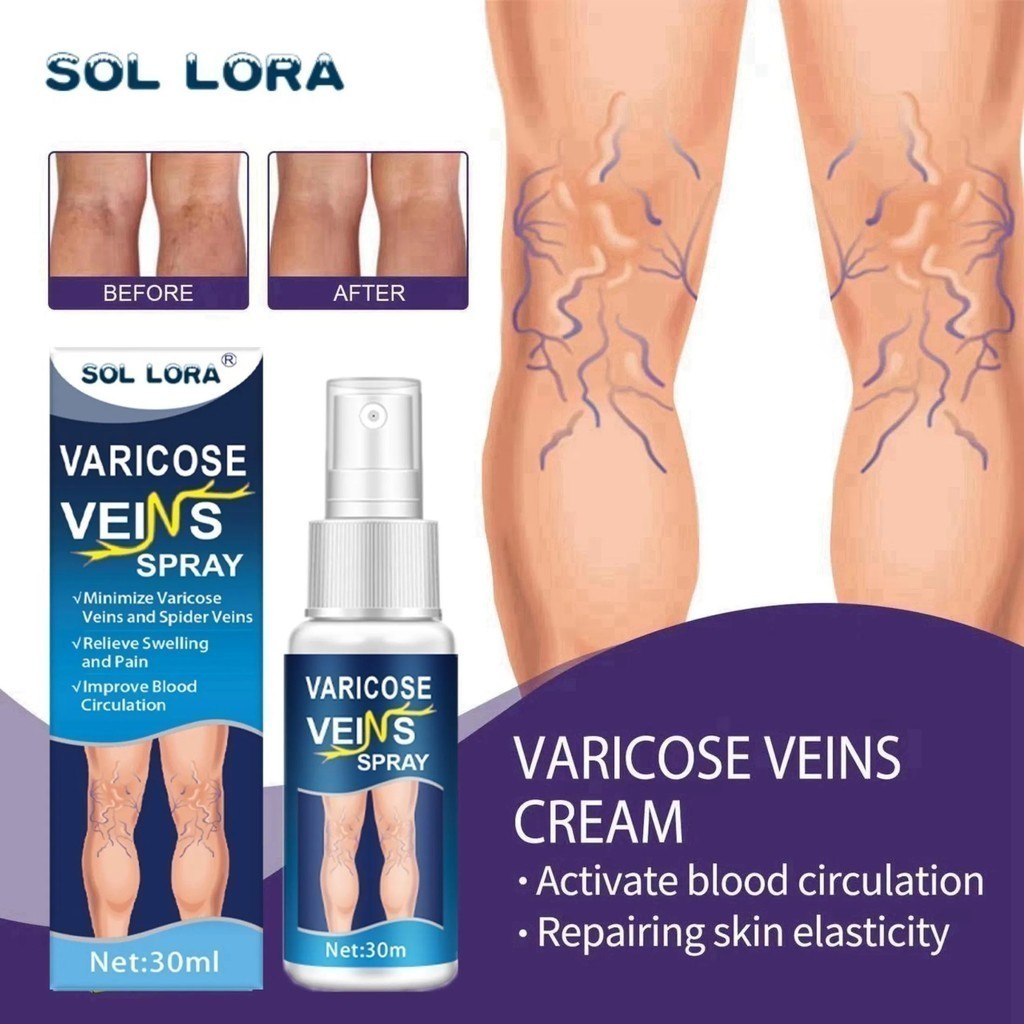 SOL LORA Varicose Veins Spray Obat Varises Salep Penghilang Varises Vaskulitis / Parises Ampuh Tanpa