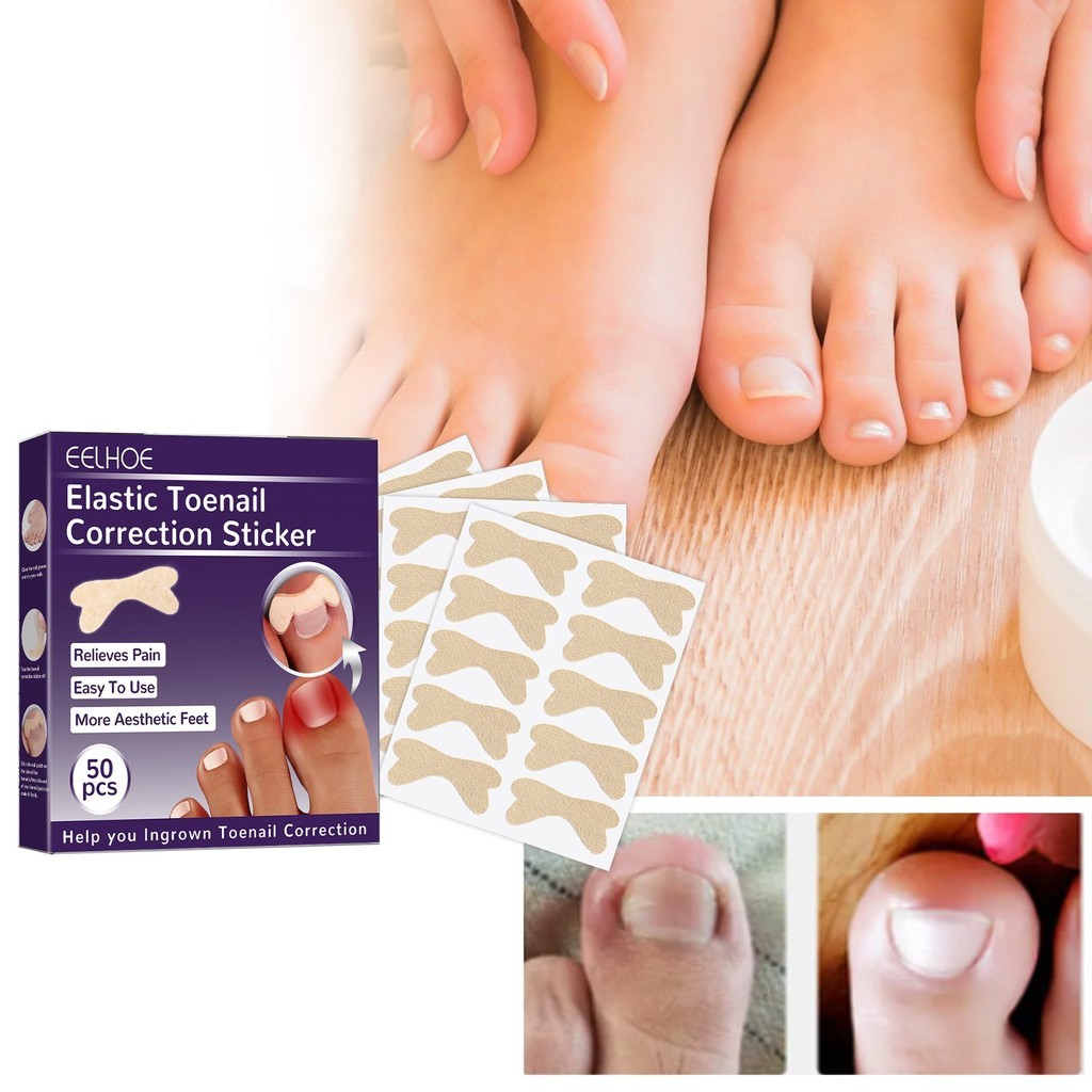

EELHOE Stiker Korektor Kuku Kaki Adhesive Ingrown Toenail Patch 50 PCS - EH-50 TERLARIS