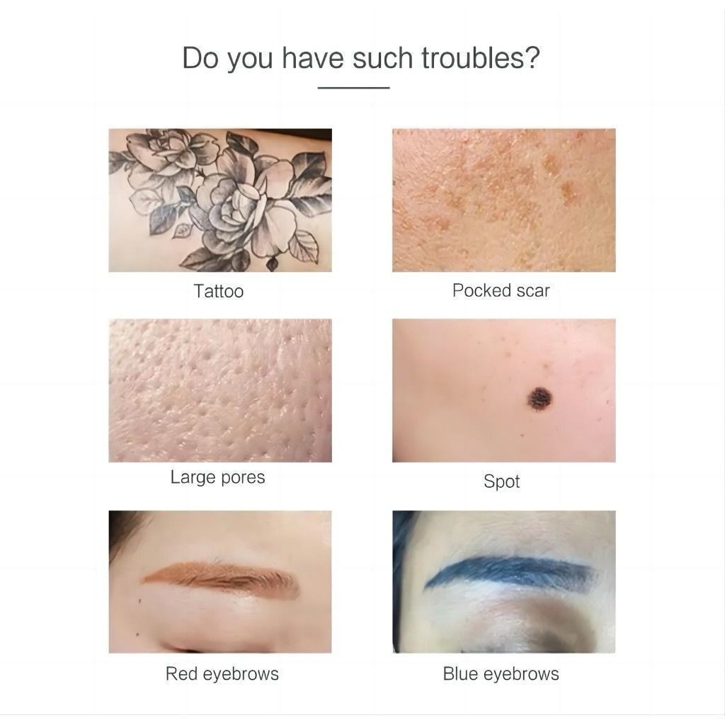 Alat Laser Picosecond Alat Laser Picolaser / Laser Tatto Removal / Alat Penghilang Tatto ND YAG