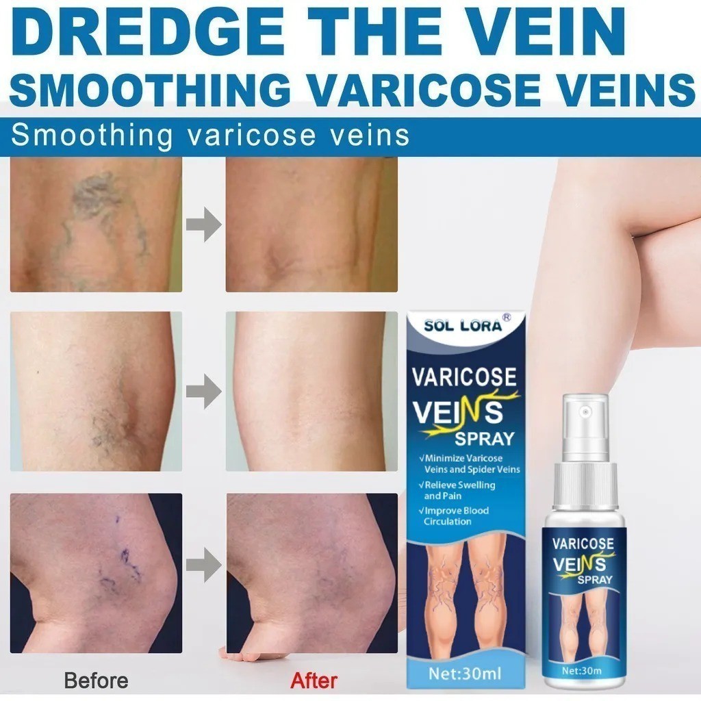 SOL LORA Varicose Veins Spray Obat Varises Salep Penghilang Varises Vaskulitis / Parises Ampuh Tanpa