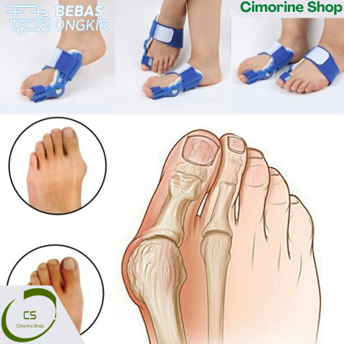 Janet (Beli 1 Dapat 2) Alat Terapi Koreksi Bunion Jempol Kaki ORI CS