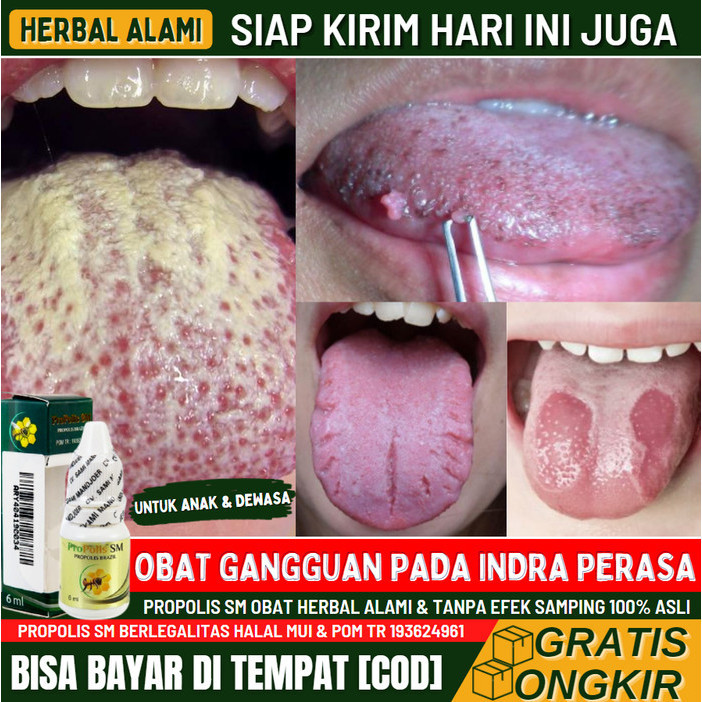 Obat Infeksi Jamur Pada Lidah, Radang Lidah, Lidah Putih, Propolis SM