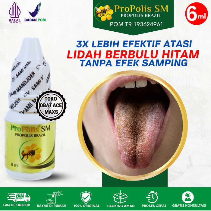Obat Lidah Berbulu Hitam, Black hairy tongue,Lidah Hitam - PROPOLIS SM