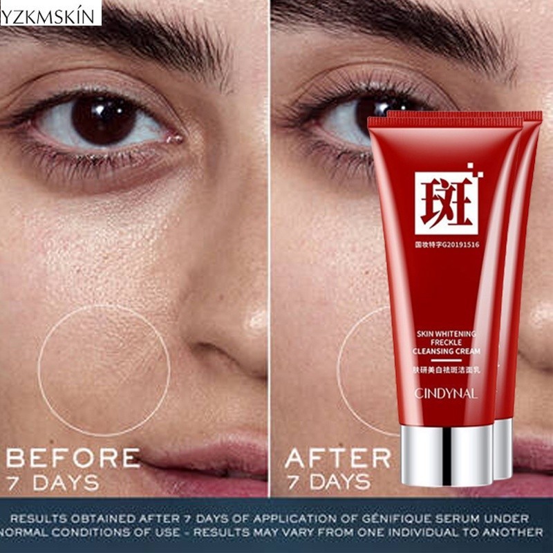 Cindynal Skin Whitening Freckle  Pembersih wajah  Penghilang Jerawat & bekasnya dan komedo serta fle