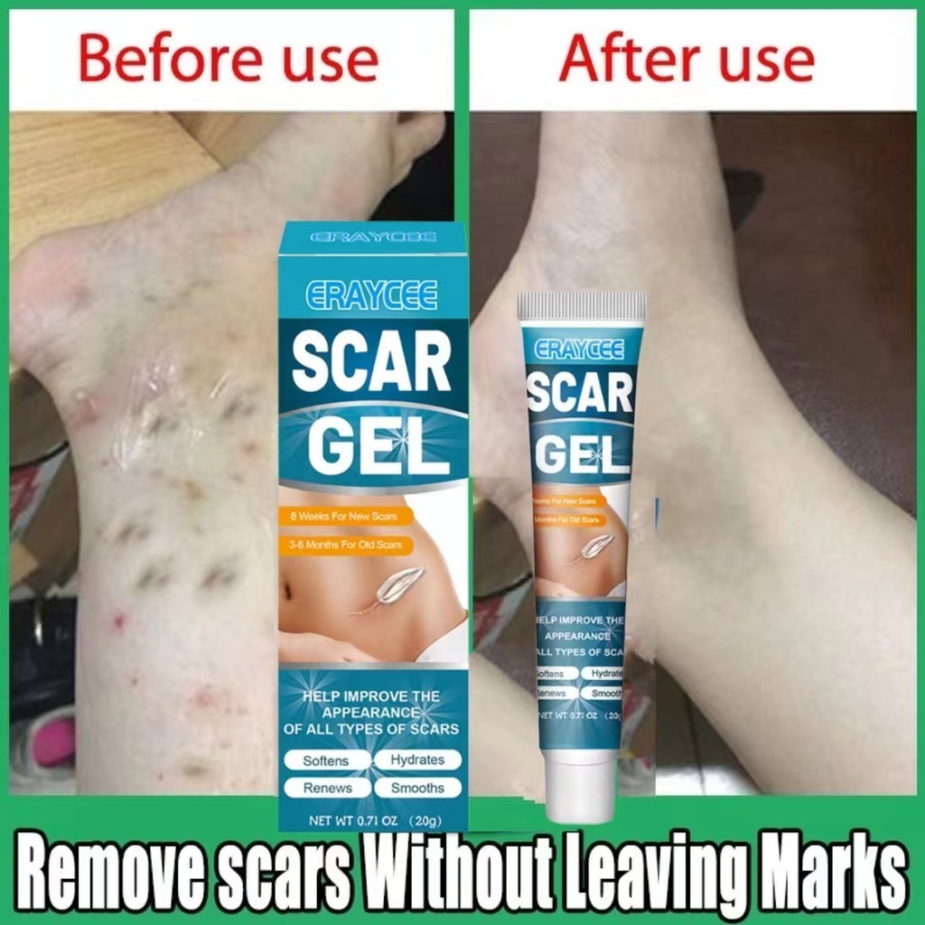 Cream Penghilang Bekas Luka Operasi Min Krim Keloid penghilang bekas luka lama/Penghilang Bekas Luka