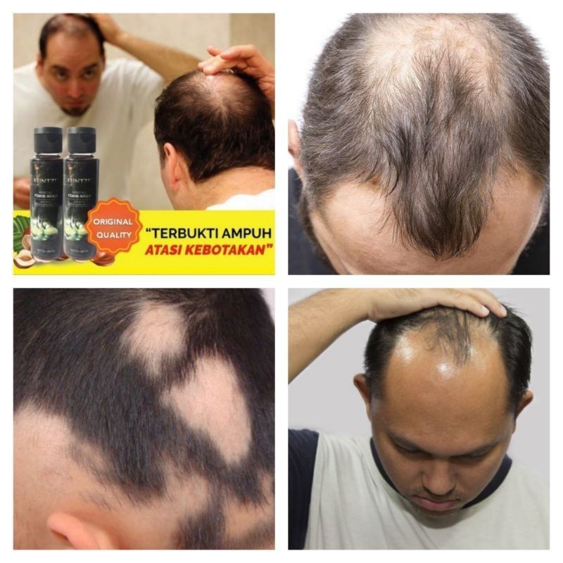 Penghitam Rambut Penghilang Uban Alami Minyak Kemiri Kuntze