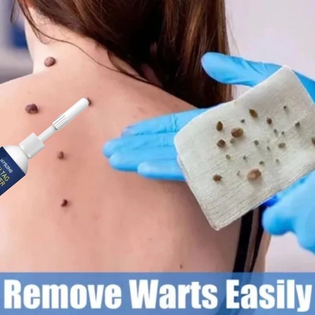 Jaysuing REMOVER Menghilangkan Kutil Tahi Lalat Mata Ikan / Wart Remover Ointment