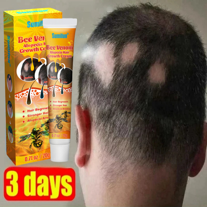 Obat penumbuh rambut Obat Alopecia Areata Rambut Pitak 20g penumbuh rambut cepat serum, penumbuh ram