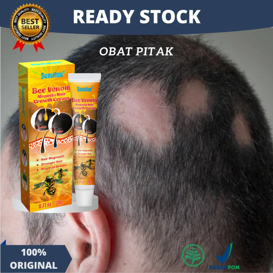 Sunmifun Obat Alopecia Areata, Obat Penumbuh Rambut Botak, Obat Botak Koin, Obat Banyak Pitak, Obat 