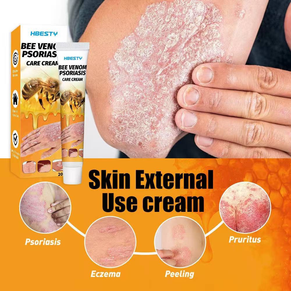 HBESTY PSORIASISCARE CREAM herbal Cina khusus untuk psoriasis membandel, psoriasis, jock itch, salep