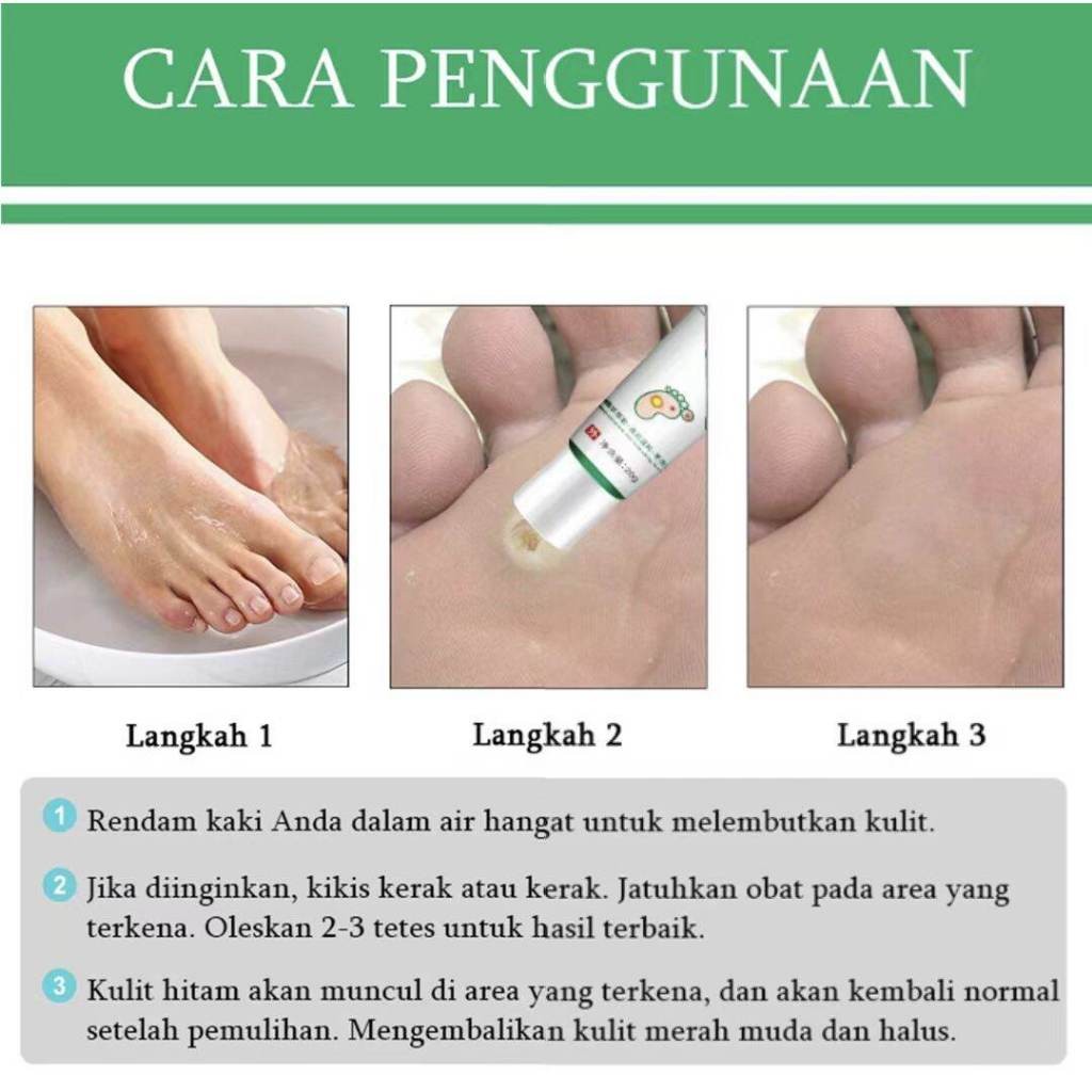 Salep Mata Ikan Ampuh Obat Mata Ikan Kaki Penghilang Mata Ikan Obat Penghilang Kutil Dan Tahi Lalat