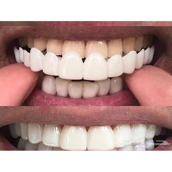 KUAT BUAT MAKAN Gigi Palsu Instan Atas Bawah Snap On Smile Original veneer gigi