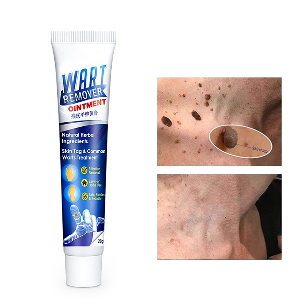 Sumifun EELHOE Wart Remover Cream Herbal Natural Ampuh Menghilangkan Kutil Dan Tahi Lalat