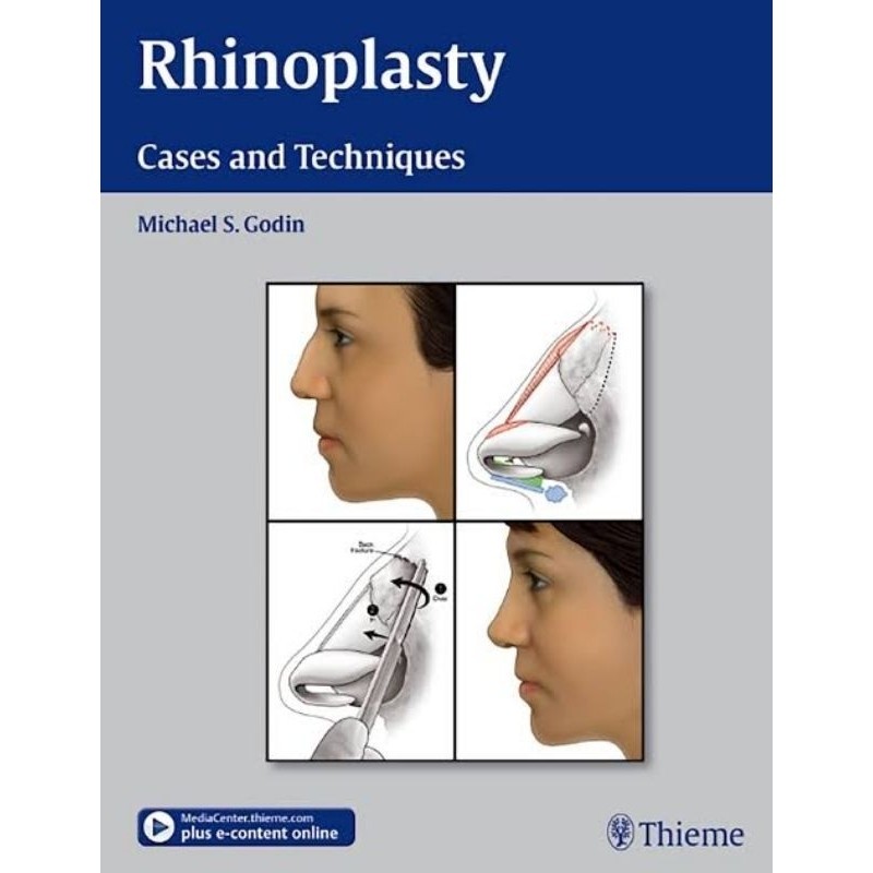 Gudangnya Pdf Rhinoplasty Cases and Techniques 2012