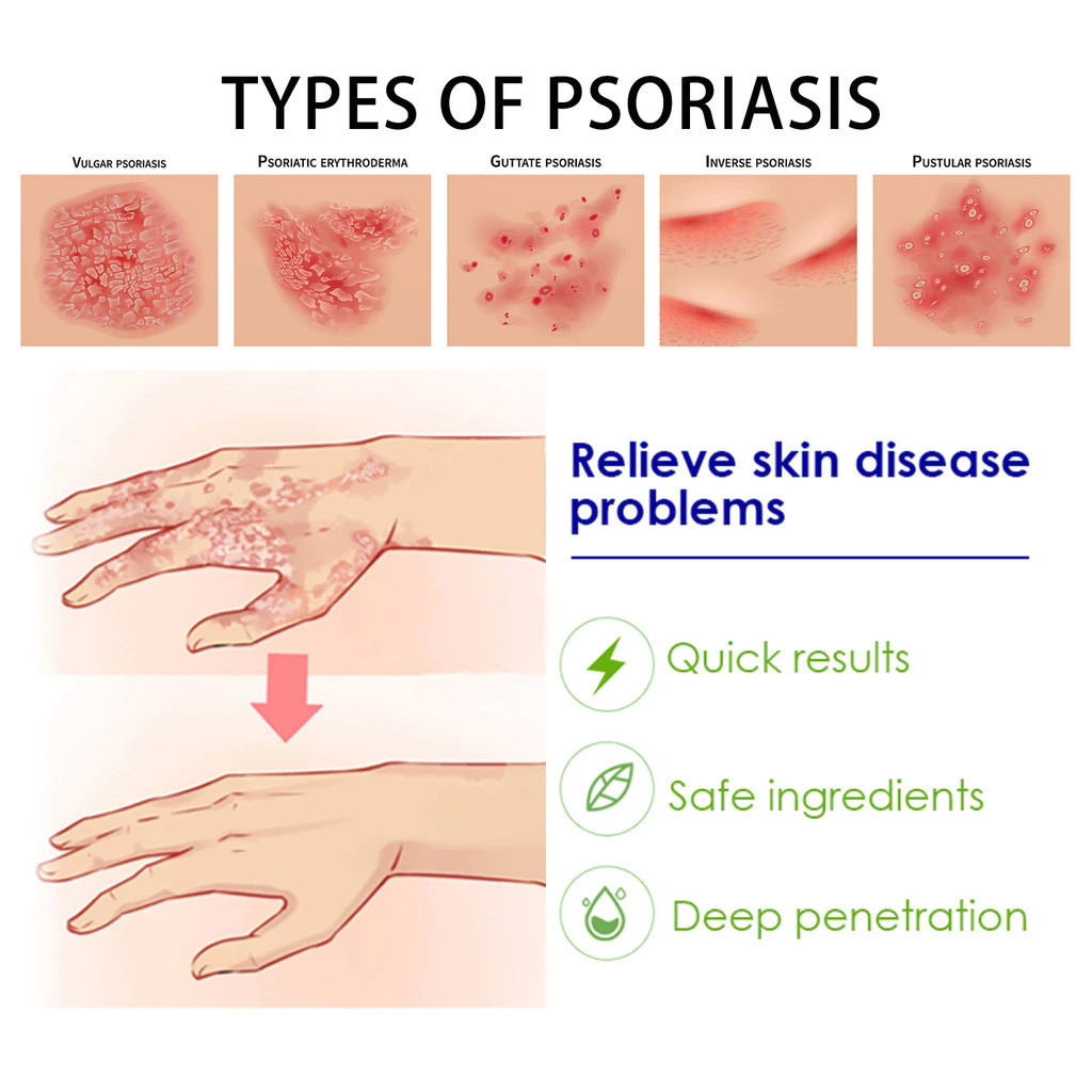 AMND Salep Khusus Psoriasis Obat Gatal Eksim Krim psoriasis paling ampuh Kulit Kepala Psoriasis