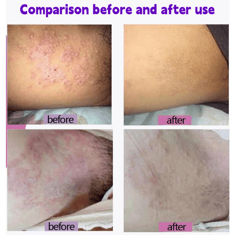 New Salep gatal paling ampuh Salep gatal selangkangan Salep gatal pada miss v Anti jamur Salep