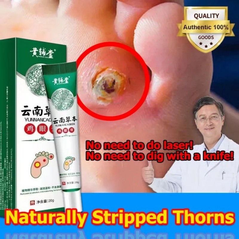 Callus Ointment 20g/Callus Ointment/Wart Removal Ointment/Fish Eye Ointment/Calluses/Foot Callus Rem