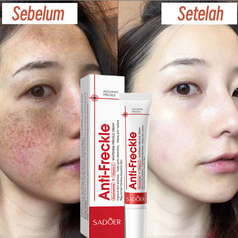 Salep Flek Pemutih Efektif Menghilangkan Melasma Hitam Bintik100% Original Treatment Melasma dan Fle