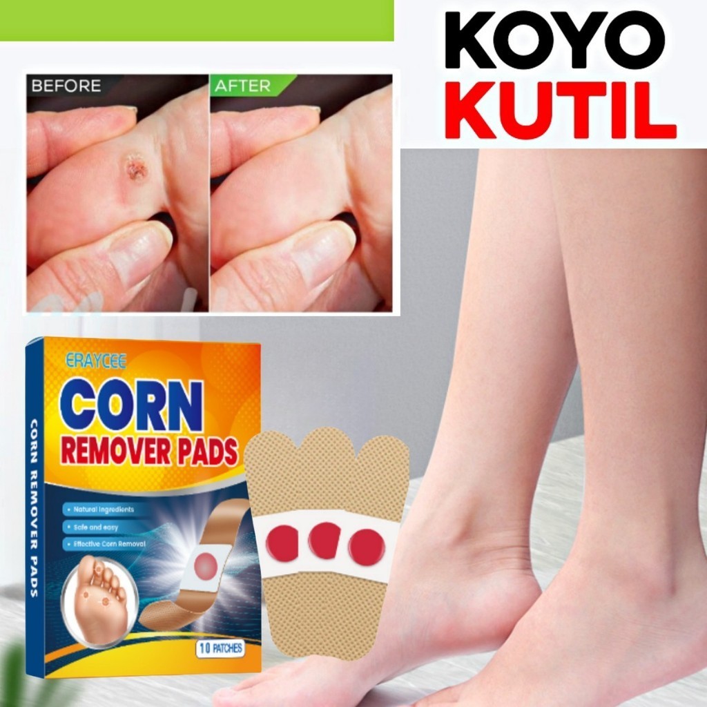 10PCS ERAYCEE Plester Kutil Mata Ikan Obat Kutil Mata Ikan Tahi Lalat Plester Kutil Penghilang Penca