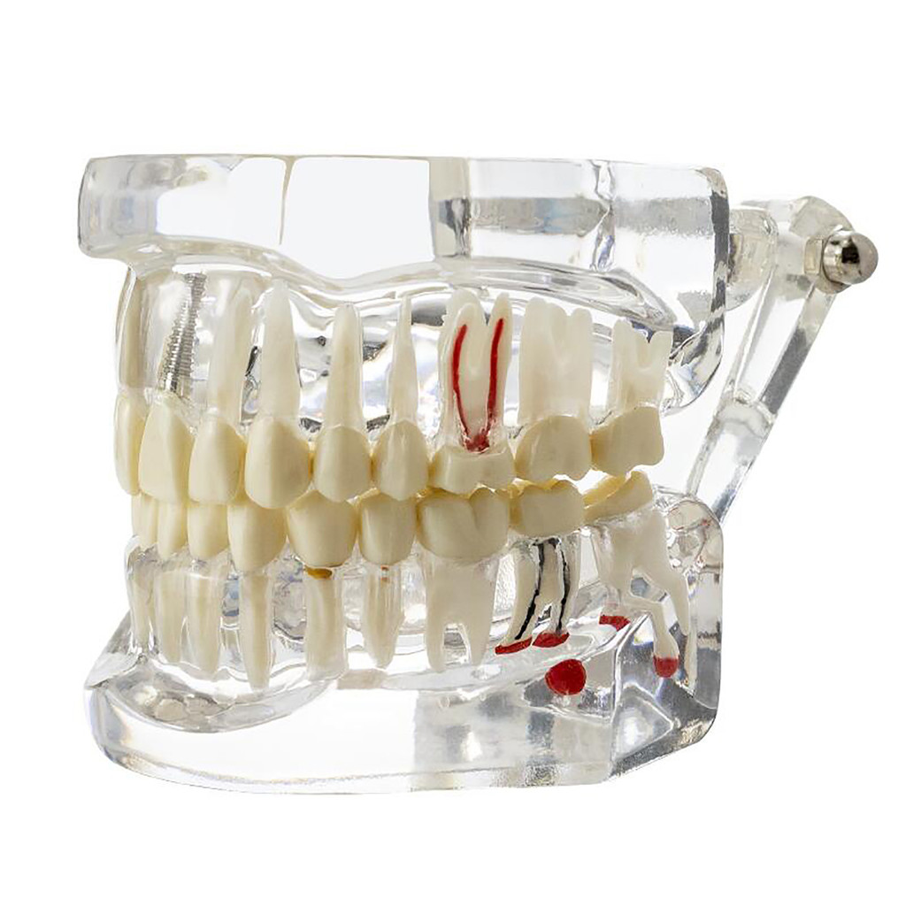 

Dental Disease Implant Teeth Model 3 Unit Bridge Restoration Teach Study Training Demo for Dental College M2001 Clear