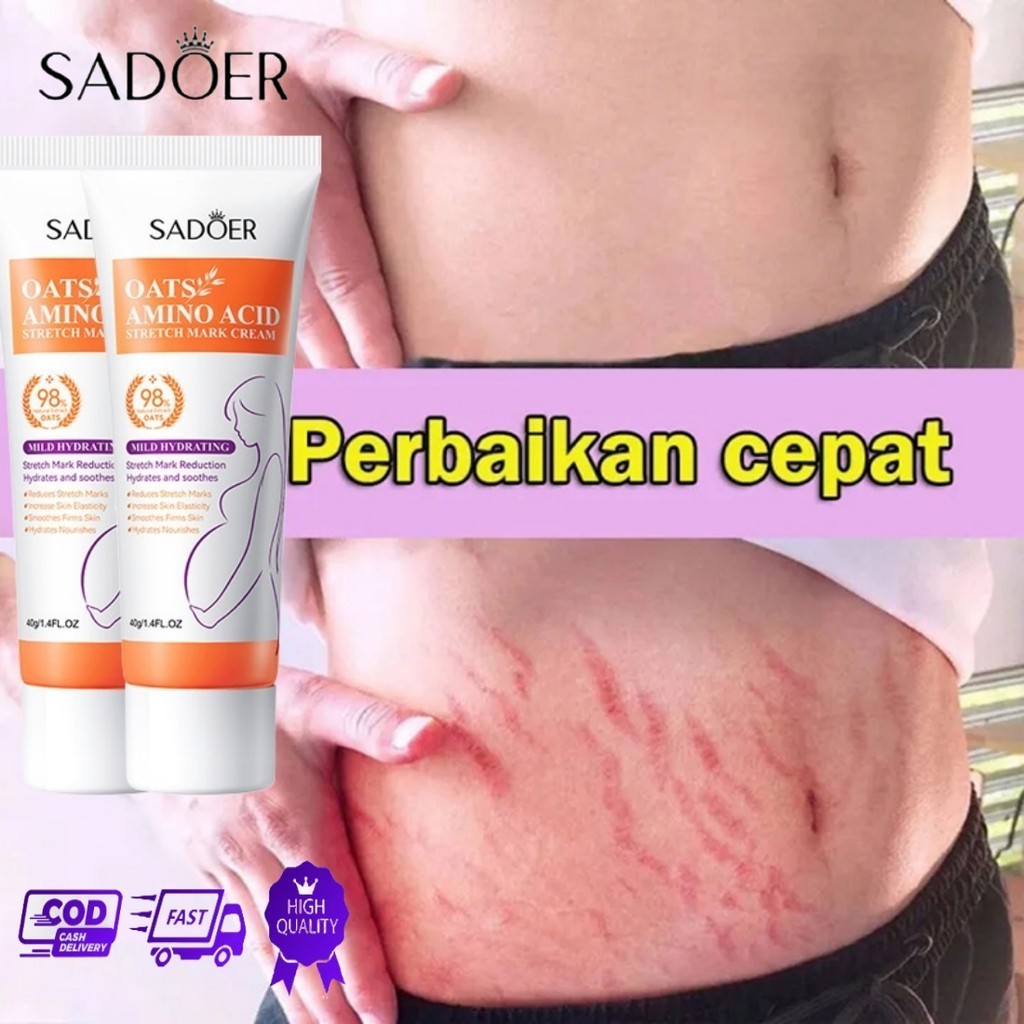 SAODER stretch mark cream Krim Penghilang Stretch Mark Krim Stretch Mark Ori BPOM Stretch Mark Cream