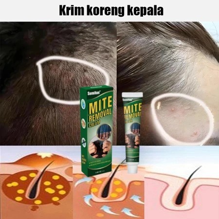 Membasmi tungau dan membunuh bakteri, mengurangi peradangan dan meredakan gatal, meningkatkan kualit