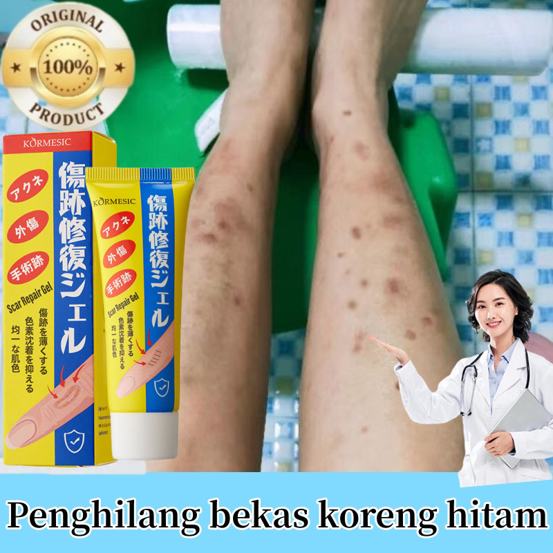KORMESIC Penghilang bekas luka hitam koreng Penghilang bekas luka di kaki Penghilang Bekas cacar Bek