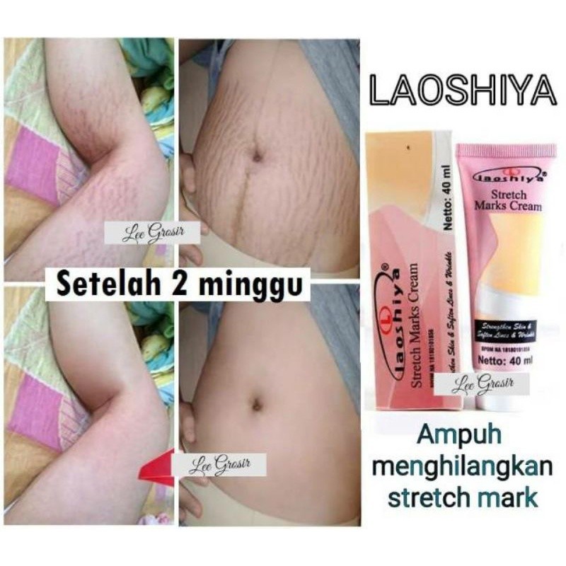 Penghilang Strechmark Salep Penghilang Bekas Luka Penghilang Selulit Penghilang Keloid Ampuh