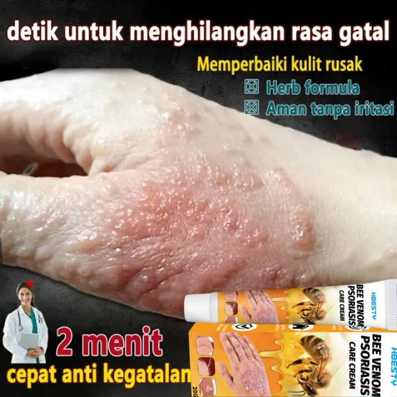 loli Salep Khusus Psoriasis Obat Gatal Eksim Krim psoriasis paling ampuh Kulit Kepala Psoriasis