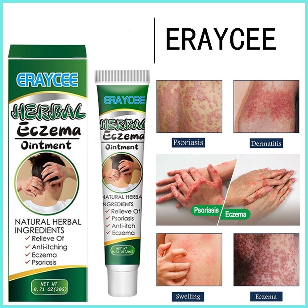 paling ampuh Kulit Kepala Psoriasis Tangan Tinea psoriasis cream dermatitis eczematoid eczema Herbal