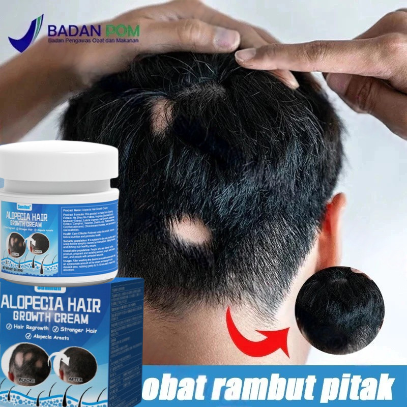 Sunmifun Obat Alopecia Areata, Obat Penumbuh Rambut Botak, Obat Botak Koin, Obat Banyak Pitak, Obat 