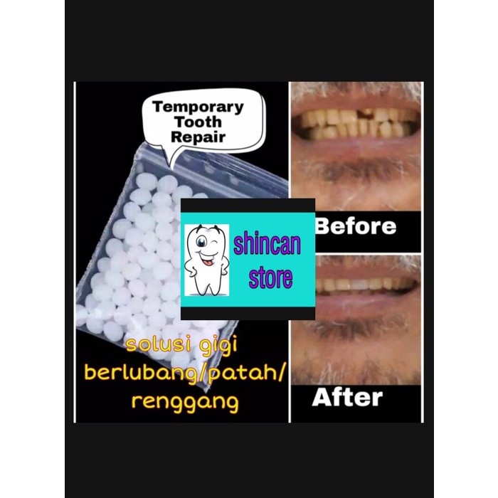 Gel Penambal Gigi 310 BUTIR / GIGI PALSU / PENAMBAL GIGI / LEM GIGI TCI