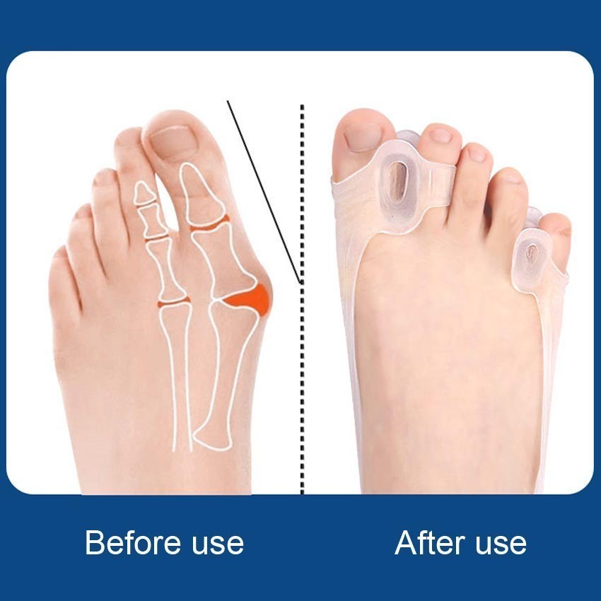 ISA 2Pcs Korektor Jempol Kaki Corrector Ori - Alat Terapi Jempol Therapy Corrector - Bunion - Hallux