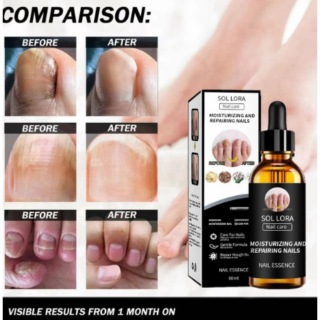 Obat Jamur Kuku jamur dan rusak Nail Care Anti Jamur Perawatan Ampuh Nail Strengthener Nail Repair P