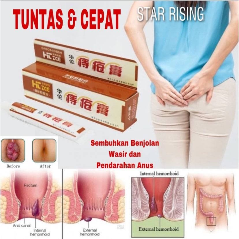 

Produk HUATUO ZHICHUANG Salep Wasir Ambeyen Ambeien BAB Sakit - BAB Tidak Lancar