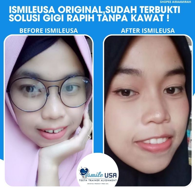 Alat Perapih Gigi Maju Tonggos Ismile USA Original 100% Garansi / Perapih Gigi Ismile USA Original /