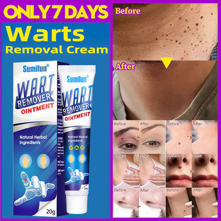 Krim Penghilang Kutil Dan Tahi Lalat Obat Kutil Di Leher Salep Kutil Paling Ampuh Obat Kutil Kelamin