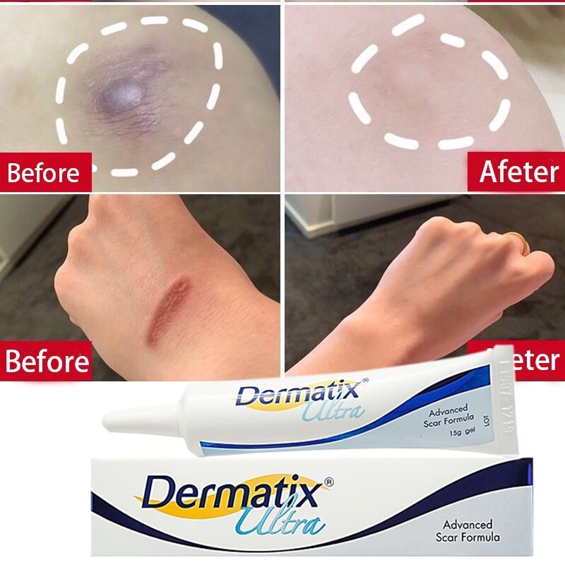 Ori Dermatix Ultra Cream Penghilang Bekas Luka 15gr Dermatix Ultra Gel Advanced Scar Formula Gel