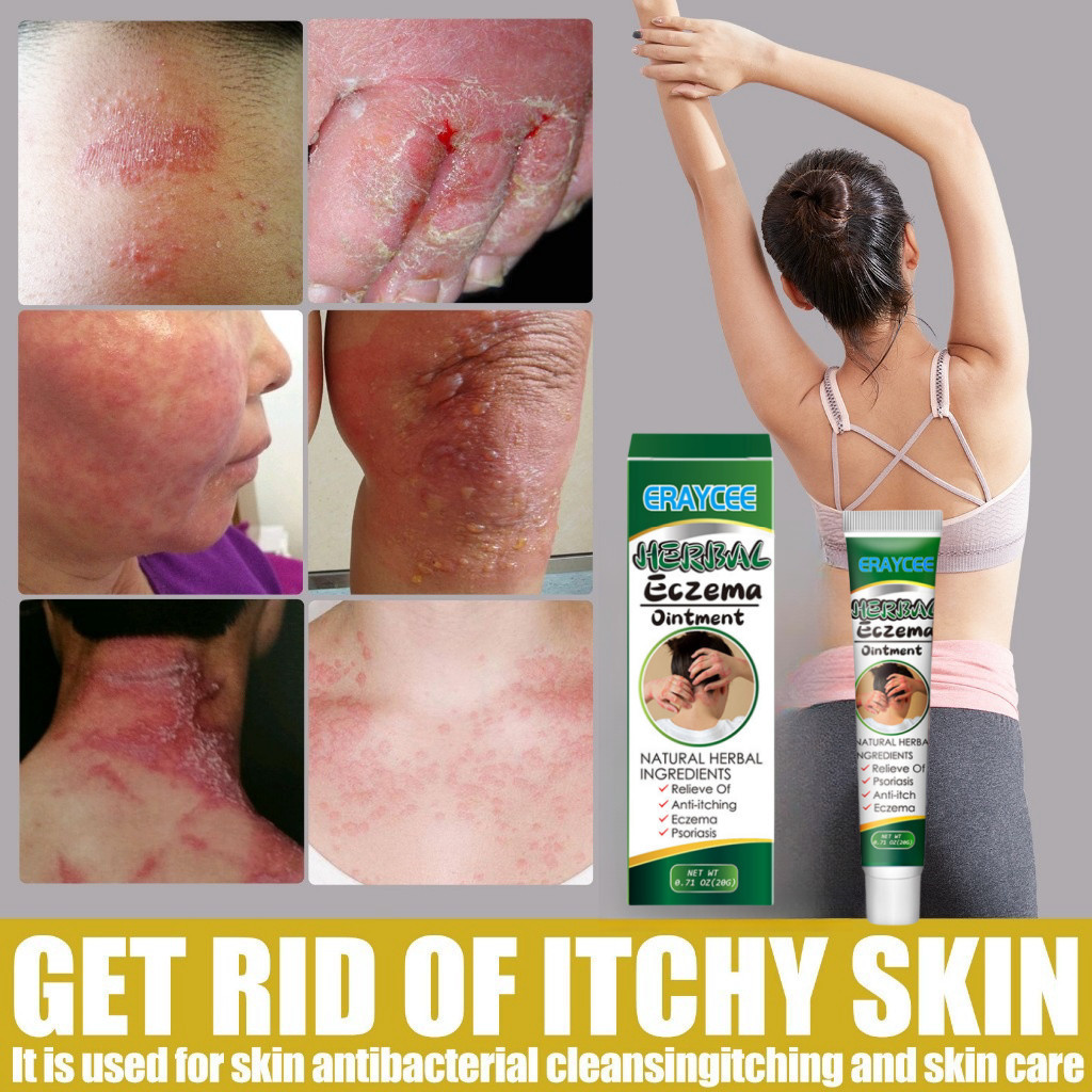 Herbal Skin Psoriasis Cream Dermatitis Treatment Eczema Cream Antibacterial Cream Relief Skin  Obat 