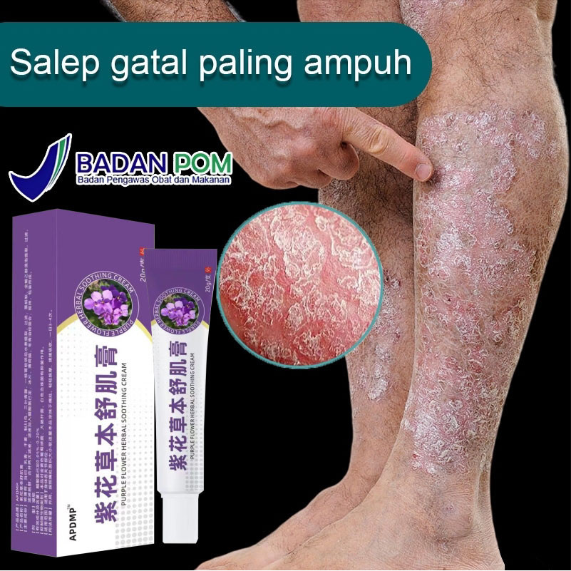 Salep gatal psoriasis/Obat Gatal Di Pantat/ALERGI GATAL Jamur/JERAWAT EKSIM PSOARISIS (SALEP GATAL)