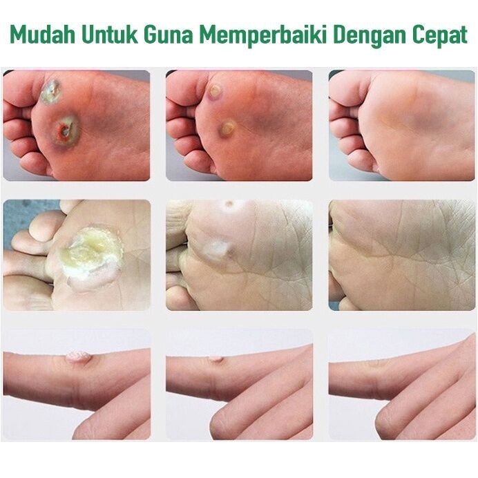 ISA Salep Mata Ikan Ampuh Obat Mata Ikan Kaki Penghilang Mata Ikan Obat Penghilang Kutil Dan Tahi