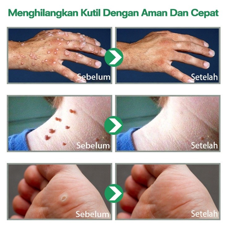 ADY78 Obat kutil paling ampuh salep kutil obat kutil di leher penghilang kutil dan tahi lalat 10ml