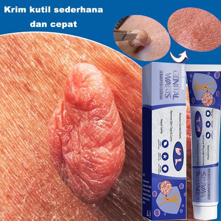 Wart Removal Cream Krim Kutil Obat Kutil Penghilang Tailalat Salep Penghilang Kutil Menghilangkan Ku