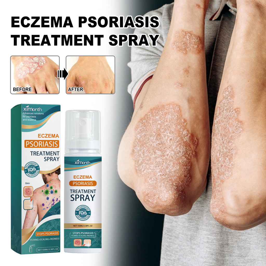 Salep gatal paling ampuh spray gatal selangkangan salep gatal kulit yang ampuh Salep gatal