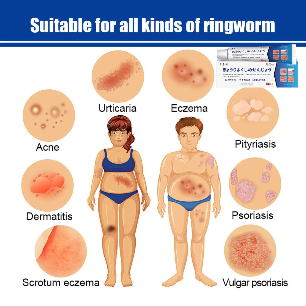 AMND Salep Alergi Kulit Gatal Eksim Salep Gatal Kulit Ampuh Cina gatal selangkangan 20g Cocok untuk