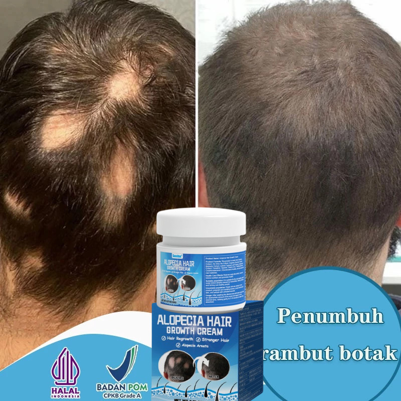 Sumifun Obat Pitak Obat Alopecia Areata, Obat Penumbuh Rambut Botak, Obat Botak Koin, Obat Rambut Pi