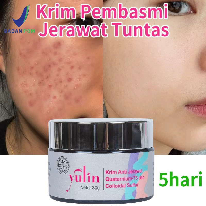 BPOM | COD YULIN Krim Pembasmi Jerawat Tuntas krim Anti Jerawat Mencerahkan Wajah Bebas kulit Halus 